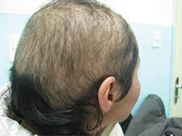 Your child's pediatrician or a pediatric dermatologist should be able to diagnose. Hair Loss In Children Etiologies And Treatment Intechopen