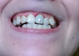 Cu cât este mai mult melanina, cu atât este mai întunecată ochiul. Comentarii IntrebÄri Si RÄspunsuri Dr Aristide Dentist Bun In Bucuresti