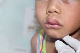 Image result for Angioedema