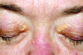 However, the spots can affect people's your health care provider should be able to diagnose xanthelasma after closely examining the skin around your eyes. Lasers May Be Effective For Treating Xanthelasma Mdedge Dermatology
