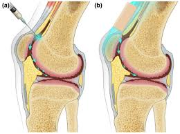 Image result for Knee Joint Injection