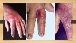 Image result for Erysipeloid