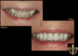 There are many factors that go into. How Much Do Porcelain Veneers Cost