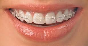 One Of The Most Heard Dental Myth Is That Braces Are Just For Kids The Fact Is If You Have Misaligned Tooth And Needs Clear Braces Dental Braces Teeth Braces
