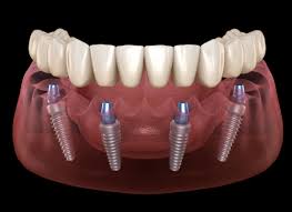 Check spelling or type a new query. What Can I Expect After An All On 4 Dental Implant In Temecula Valley