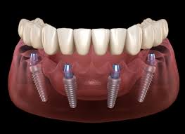 Usually novocaine or another similar local anesthetic is all that is necessary to eliminate discomfort during dental implant placement. What Can I Expect After An All On 4 Dental Implant In Temecula Valley