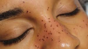 They are meticulously placed on areas such as the cheeks, nose, lips, shoulders, collarbones most commonly, but can ultimately be placed where ever you like. The Weird Irony Of Australia S New Freckle Tattoo Trend Guide