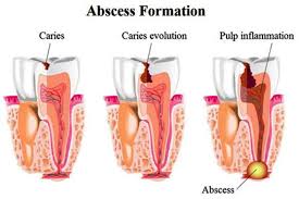 How to get rid of wisdom tooth infection. How To Cure An Abscess Tooth Pain Dental Abscess Treatments Remedies