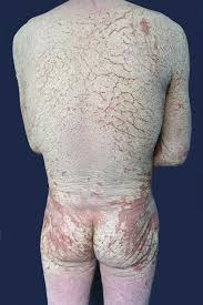 Image result for scabies norvegica