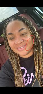 What are these little red bumps