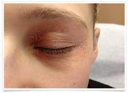 For some people, it flares periodically and then clears up for a time, even for several years. Truelipids Eyelid Dermatitis Care Eyelid Dermatitis Dermatitis Remedies Face Eczema Treatment