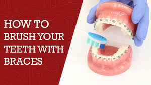Squeeze the lugs on the brackets together with a pair of pliers. Brushing Your Teeth With Braces Is More Important Than Ever You Need To Remove Food From Brackets As Soon As You Can Brushing Teeth How To Brush Orthodontics