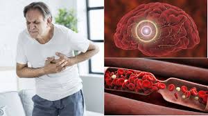 Thrombus, blood clot (blood clot formed in blood vessels that leads to thrombosis). Tromboza Moze Ugroziti Zivot Ali Ako Se Prepozna Na Vrijeme Uspjesno Se Lijeci 24sata