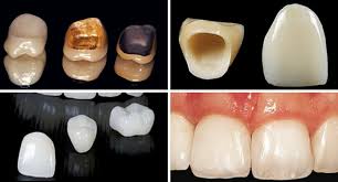 Maybe you would like to learn more about one of these? What Is The Typical Cost Of A Dental Crown