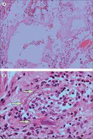 Image result for Strongyloides