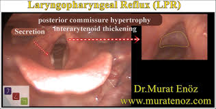 Image result for Reflux Laryngitis
