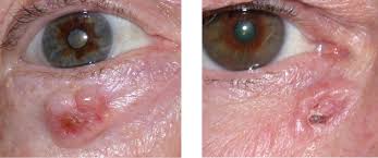 Having fun in the sun sounds like a great idea. Eyelid Basal Cell Carcinoma Warwar Eye Group