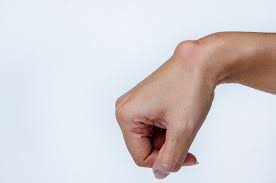 How do you get a ganglion cyst on your wrist? Ganglion Wrist Connecticut Orthopaedics