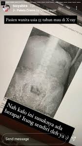 Check spelling or type a new query. Viral Foto X Ray Ratusan Jarum Di Tubuh Pasien Ini Tanggapan Dunia Medis Tentang Susuk Madiunpos Com Kisah Unik Madiunpos Com