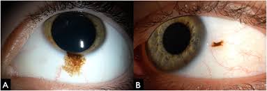 Image result for conjunctival melanoma