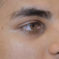 Eliminacion De Ojeras Imebelle Clinica Estetica Depilacion Laser