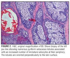 Muir Torre Syndrome A Case Report Jcad The Journal Of Clinical And Aesthetic Dermatology