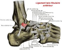 Un arrêt de travail peut être nécessaire en fonction de la gravité de l'entorse et de l'activité en général, il existe une insécurité à la course ou à la marche, parfois associée à des douleurs, et le risque à long terme est de développer une arthrose. Entorse De La Cheville Orthopedie Pour Tous