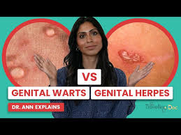 Image result for genital herpes