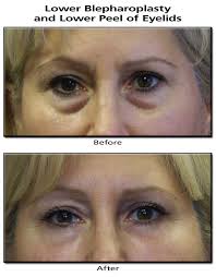 This chemical peel helps to remove excess oil and dead skin cells. Chemical Peels St Louis