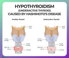 Hashimoto S Disease Symptoms Causes Risk Groups Conventional Treatment Hashimoto S Diet And Supplements For Hashimoto S Disease Ecosh Life