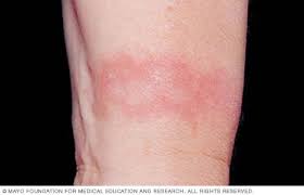 Normal sunscreen last for two hours on the face. Contact Dermatitis Symptoms And Causes Mayo Clinic