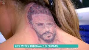 Holly Hagan reveals pain of having tattoo of ex removed