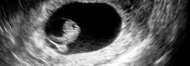 Denken sie bei der prüfung ihrer optionen daran, dass medizinische abtreibungen nur empfohlen werden, wenn sie 10 wochen schwanger sind oder weniger. Abtreibung Per Mausklick Schwangerschaftsabbruch Ohne Arztbesuch Medical Tribune