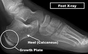 Image result for Calcaneal Apophysitis