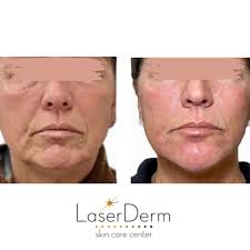 ✨LaserDerm Skin Care Center ✨