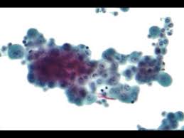 Check spelling or type a new query. Mesothelioma Cytology Mesothelioma Disease Or Medical Condition Youtube