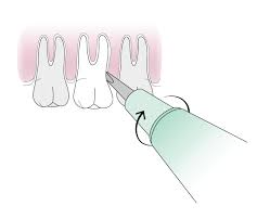 Tie one end to the tooth you want to extract. How To Do An Emergency Tooth Extraction Dental Disorders Msd Manual Professional Edition