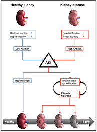 Interruption in flow can lead to serious failure. The Aftermath Of Acute Kidney Injury A Narrative Review Of Long Term Mortality And Renal Function Critical Care Full Text