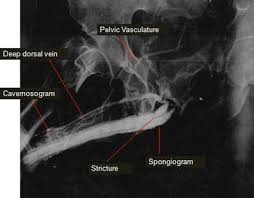 Image result for Retrograde Urethrogram