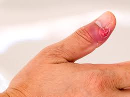 We did not find results for: Paronychia Symptoms Causes Diagnosis And Treatment
