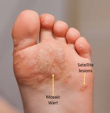 Ketuat 'peringual' berkembang di bahagian bawah dan sekitar kuku kaki dan kuku jari. Ubat Ketuat Di Kaki Curio Spa