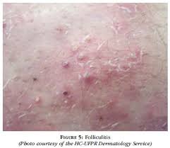 Bacterial folliculitis (folliculitis barbae) these are caused by bacterial infection of the hair follicles, especially by staphylococcus aureus. Scielo Brasil Pyodermitis Pyodermitis