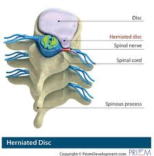 Disc degeneration or trauma can cause the nucleus to herniate through. Herniated Disc Texas Spine And Scoliosis