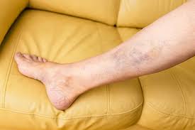 Image result for Pigment stains on the shin