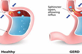 Herbal Remedies For Gastroesophageal Reflux Disease Gerd Ayurvedic Treatment