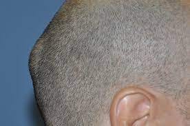 Lump on back of head. Lump On The Back Of Head Is It Dangerous