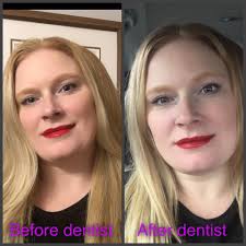 Permanent lip color procedure in Astoria