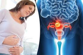 Back pain may develop in women with ovarian cancer due to fluid buildup in the pelvic area, especially if the uterus is tipped backwards, according to. Cancer Symptoms Five Womb Cancer Signs You Should Watch Out For Express Co Uk