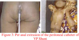The Length Of The Preitoneal Catheter In Vp Shunt Surgery A Review Semantic Scholar