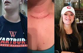Its diagnosis is not easy as the symptoms are hard to thyroid cancer is a disease that occurs when cancerous cells begin to grow in and around the therefore in case of swelling of the thyroid nodules, the trachea is pressurized thus causing. Thyroid Cancer Story I Had Thyroid Cancer For Five Years Without Knowing It Women S Health